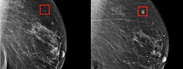 Prédire le cancer du sein cinq ans avant son apparition, possible grâce à l'intelligence artificielle 